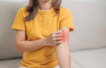 woman itching and scratching itchy arm. Sensitive Skin Allergic reaction to insect bite, food, drug dermatitis. Dermatology, Leprosy day, Systemic lupus erythematosus, Allergy symptoms and rash Eczema